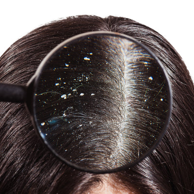 The Link Between Scalp Barrier Dysfunction and Dandruff and Seborrheic Dermatitis